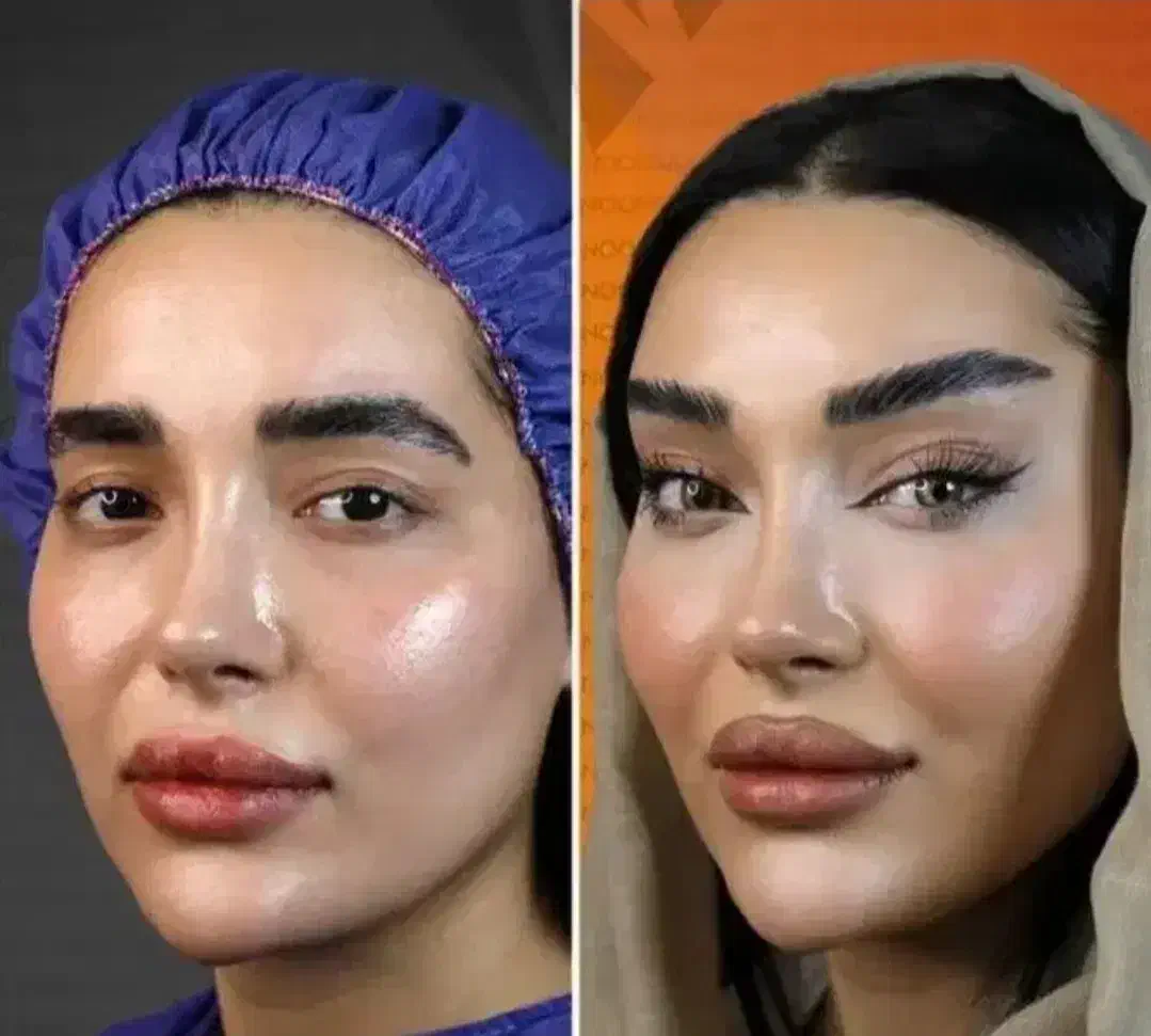 پی آر پی (prp) بایوفیلر اگزوزوم ژل فیلربادی بوتاکس|خدمات آرایشگری و زیبایی|کرج, گوهردشت|دیوار