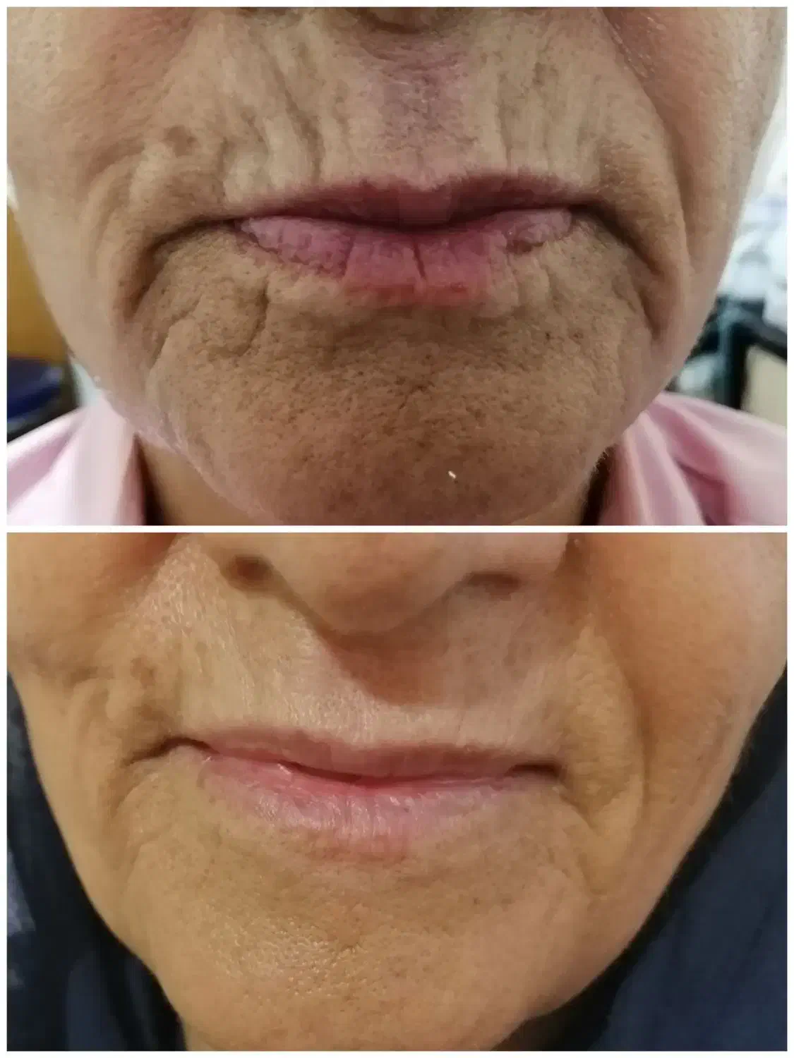 لیفت صورت و جوانسازی در یک جلسه|خدمات آرایشگری و زیبایی|شیراز, زند|دیوار