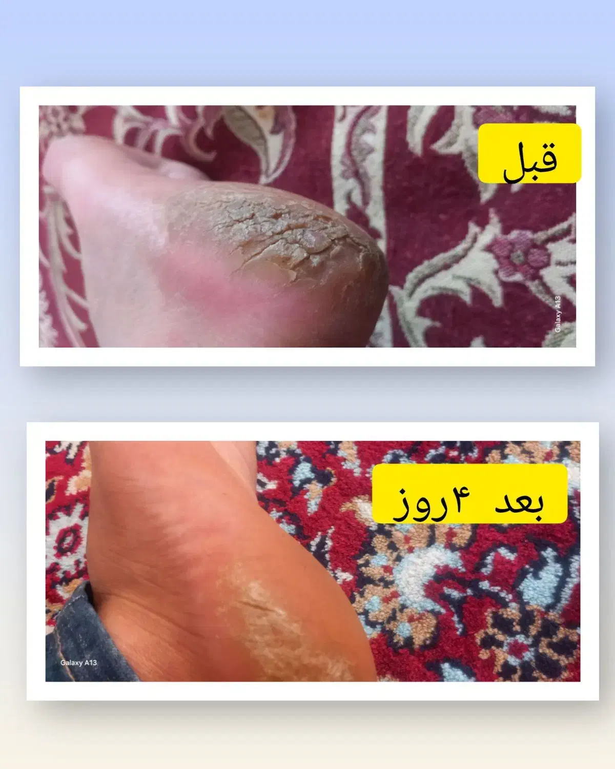 ترک پا،میخچه، اگزما|آرایشی، بهداشتی، درمانی|قروه, |دیوار