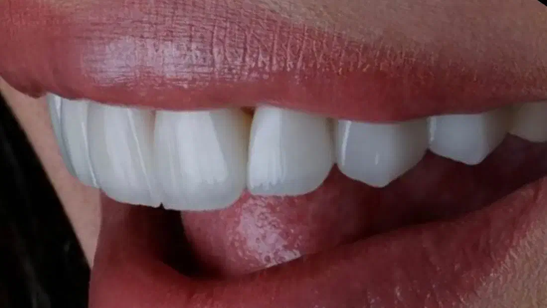 جشنواره بزرگ یلدادستدندانطبیعی+ایمپلنت+کامپوزیت|خدمات آرایشگری و زیبایی|تهران, فلسطین (میدان انقلاب)|دیوار