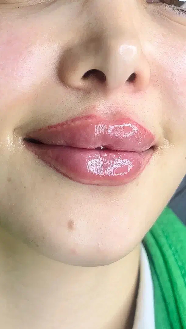 مادلینگ صورت( ژل و بوتاکس)|خدمات آرایشگری و زیبایی|زرقان, |دیوار