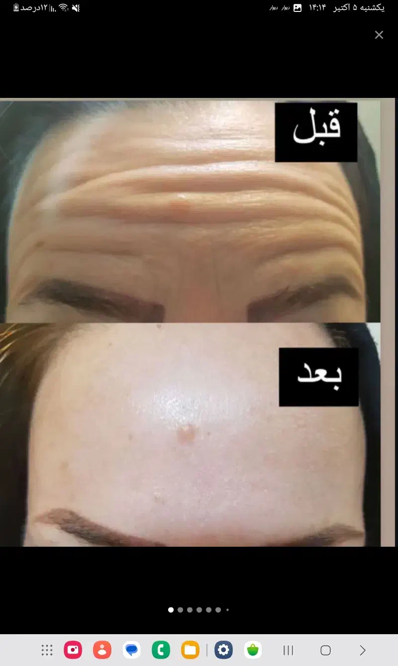 فیلر اقتصادی بوتاکس پیرسینگ|خدمات آرایشگری و زیبایی|ایرانشهر, |دیوار