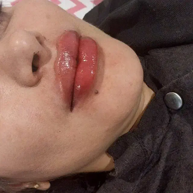 تزریق فیلر و بوتاکس لیفت نخ مزو و...|خدمات آرایشگری و زیبایی|مشهد, گلشور|دیوار