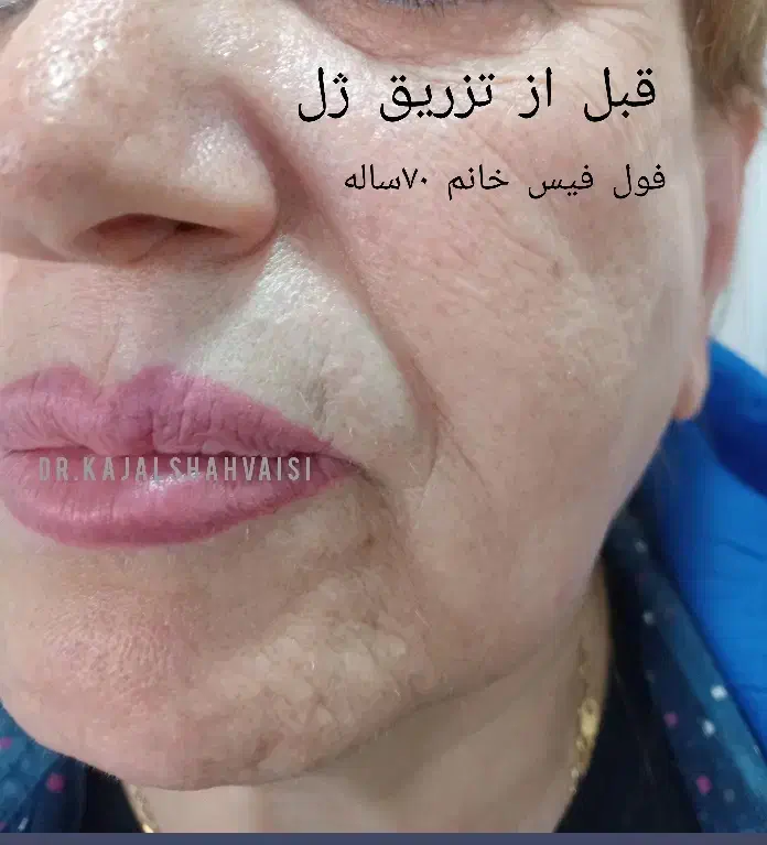 مطب زیبایی دکتر کژال شاه ویسی تزریق ژل بوتاکس..|خدمات آرایشگری و زیبایی|سنندج, |دیوار