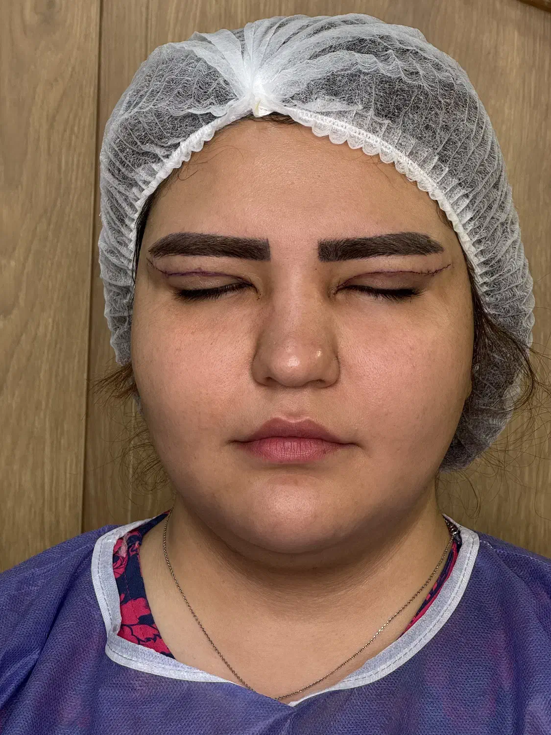 بلفاروپلاستی تضمینی تزریق فیلر بوتاکس و لیزر اقساط|خدمات آرایشگری و زیبایی|تبریز, |دیوار