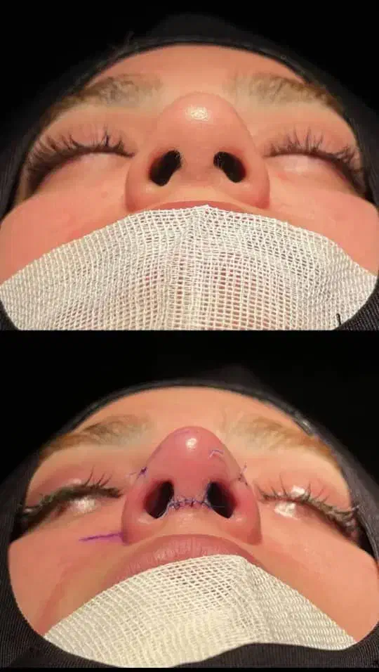 فرصت استثنایی وباورنکردنی عمل بینی بصورت اقساط|خدمات آرایشگری و زیبایی|ایذه, |دیوار