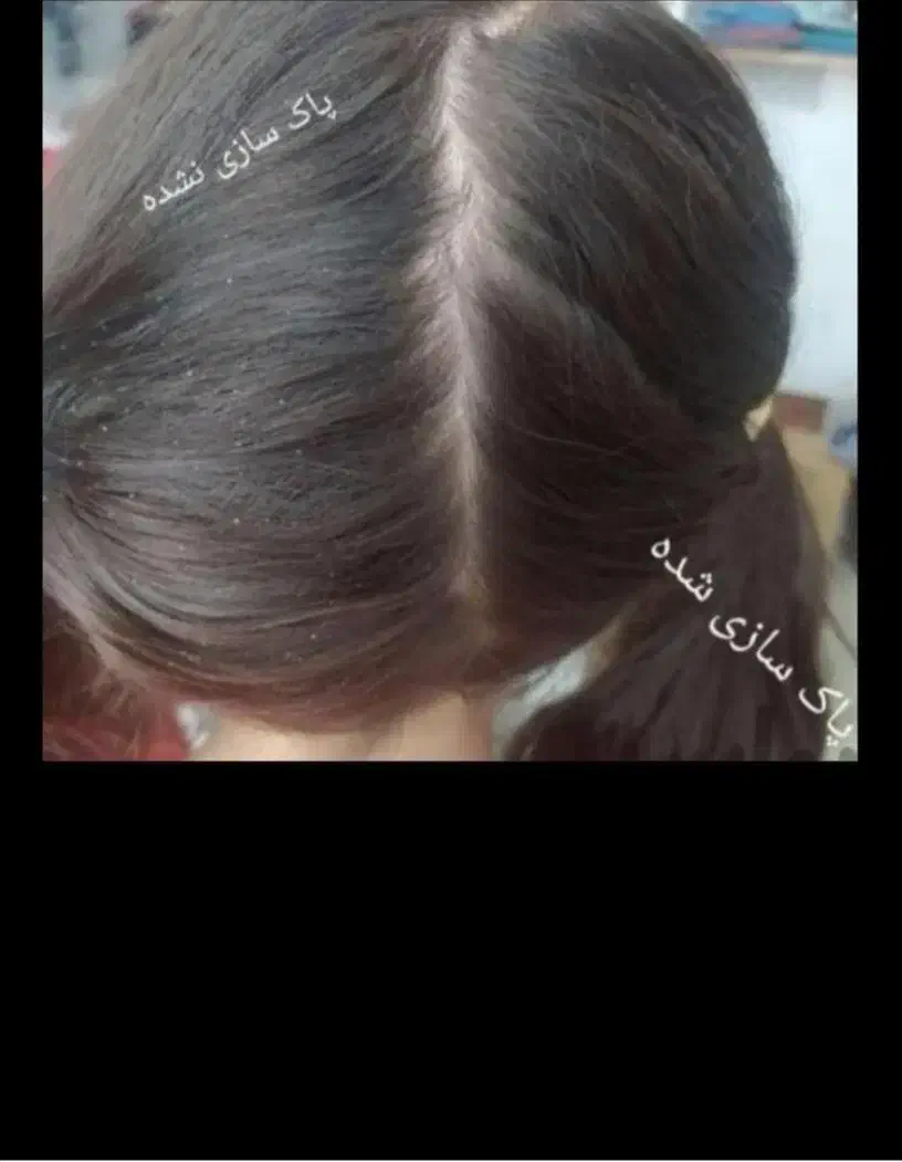 درمان قطعی رشک و شپش با ضمانت|آرایشی، بهداشتی، درمانی|سبزوار, امیر کبیر|دیوار