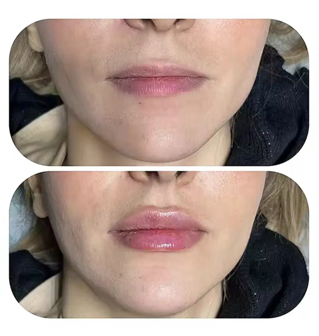 تزریق ژل و بوتاکس|خدمات آرایشگری و زیبایی|امیدیه, |دیوار