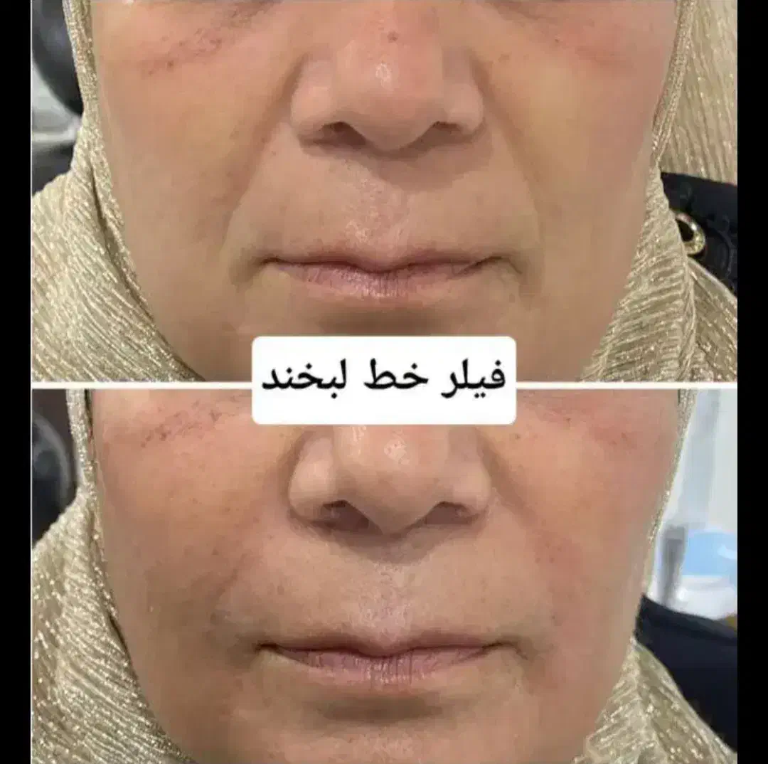 تزریق ژل وبوتاکس و آموزش فیلر با 5سال سابقه کاری|خدمات آرایشگری و زیبایی|جیرفت, |دیوار