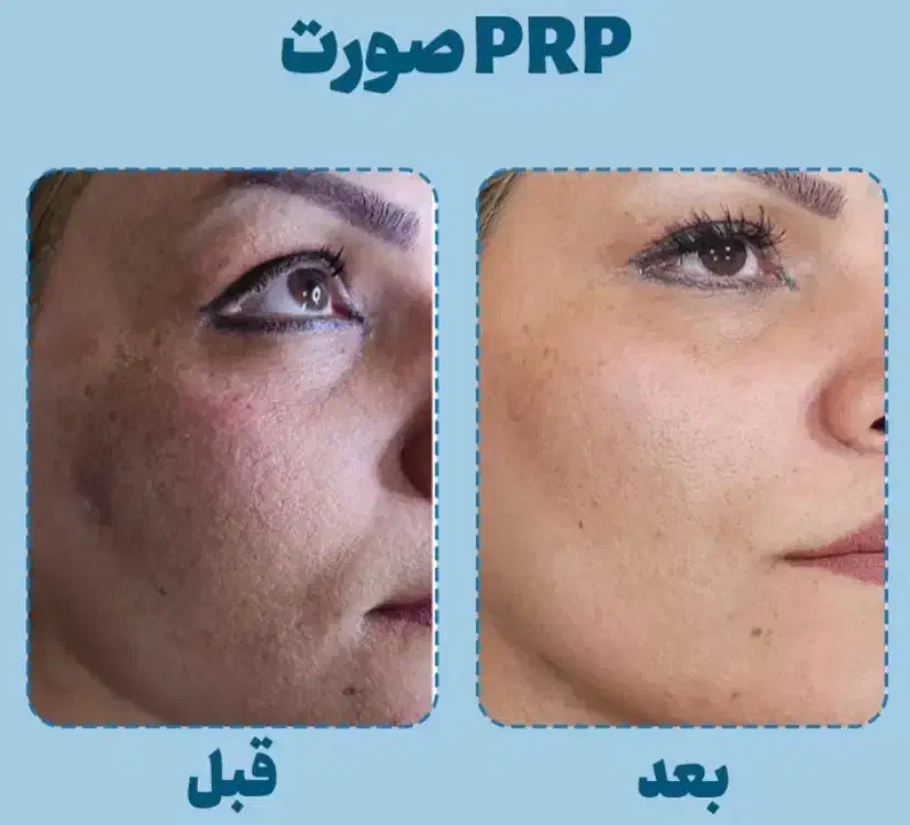 پی ار پی ،پی ار اف و مزوتراپی صورت و مو|خدمات آرایشگری و زیبایی|حمیدیا, |دیوار