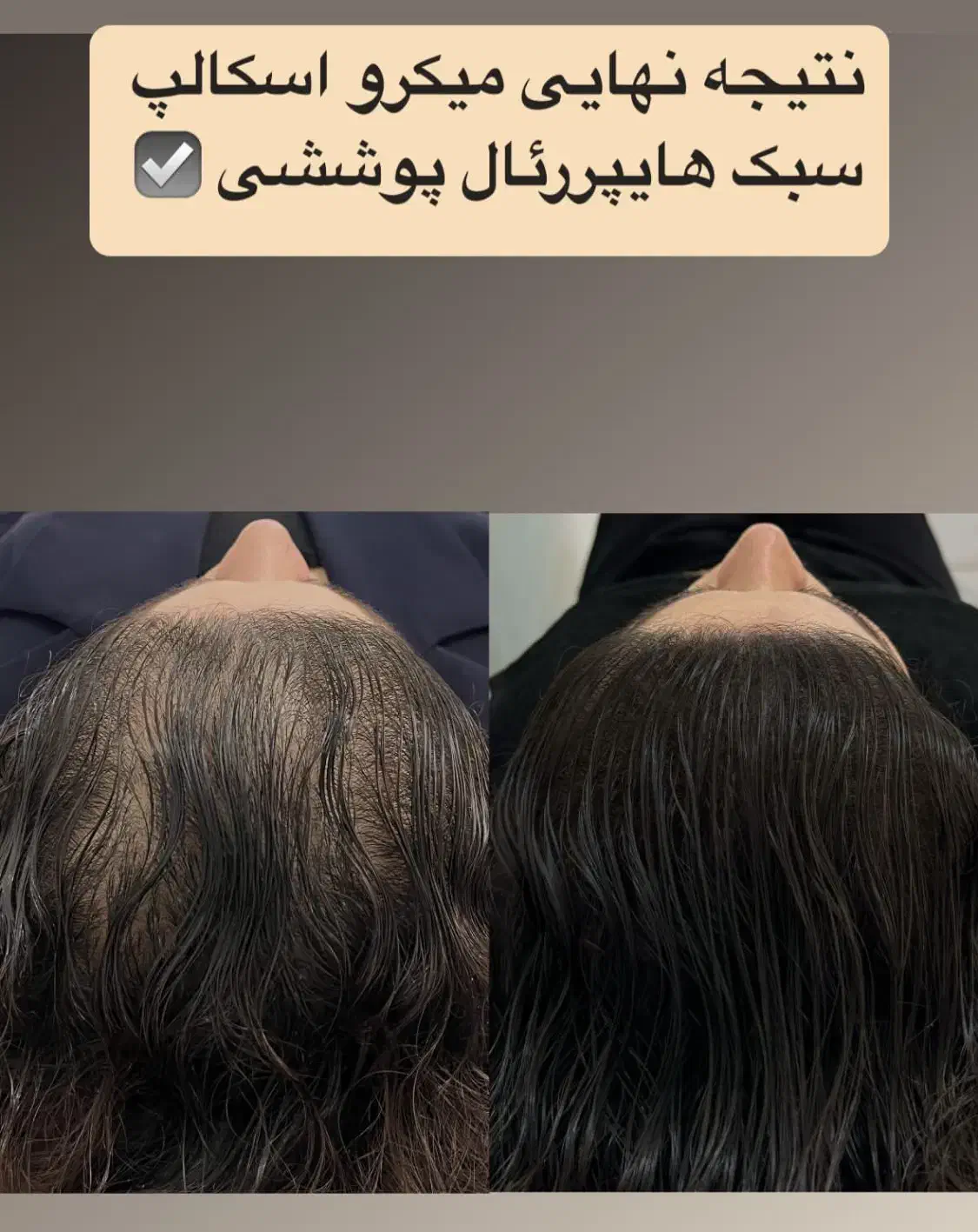 میکرواسکالپ اسکراپ کاشتمو درمجموعه زیبانو|خدمات آرایشگری و زیبایی|مشهد, گوهرشاد|دیوار