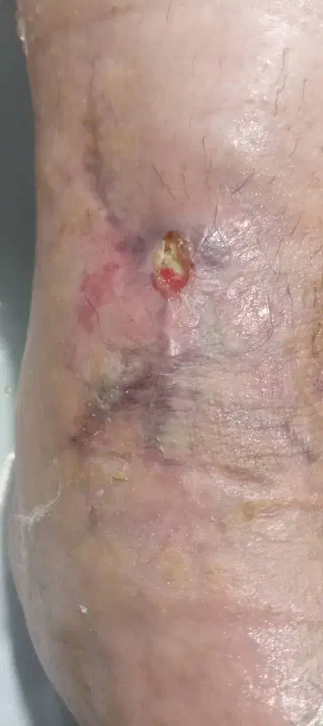 کارشناس زخم پانسمان نوین درمان در منزل|خدمات آرایشگری و زیبایی|ری, اقدسیه|دیوار