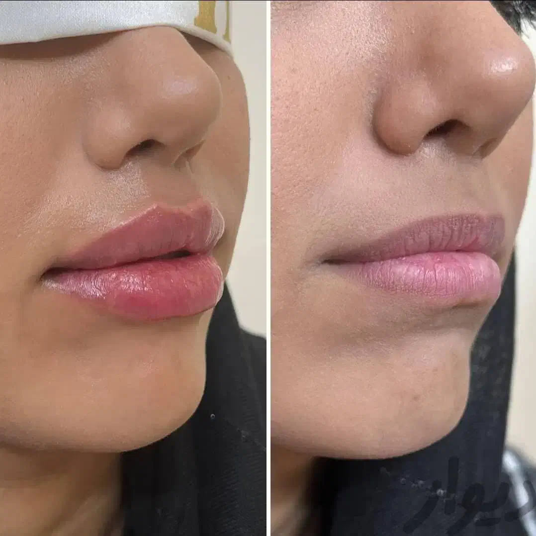 لیزر موهای زائد۲۰۲۵، بوتاکس،فیلر توسط پزشک|خدمات آرایشگری و زیبایی|تهران, جوادیه|دیوار