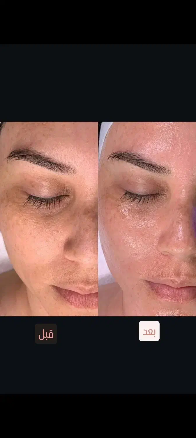 فیشال و پاکسازی پوست|خدمات آرایشگری و زیبایی|نیشابور, هفده شهریور|دیوار