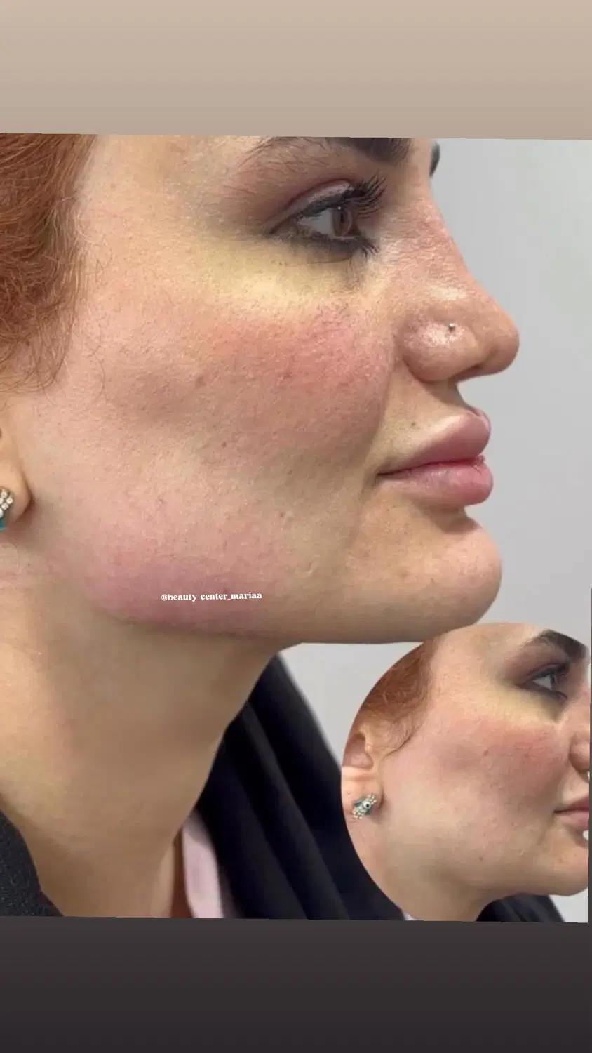 تزریق ژل و بوتاکس و شاین بادی|خدمات زیبایی و سلامت|تبریز, |دیوار