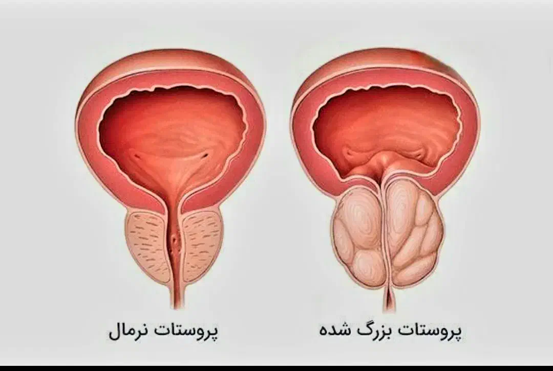 پروستات و مشکلات ج*ن*س*ی آقایان|خدمات آرایشگری و زیبایی|سیرجان, |دیوار