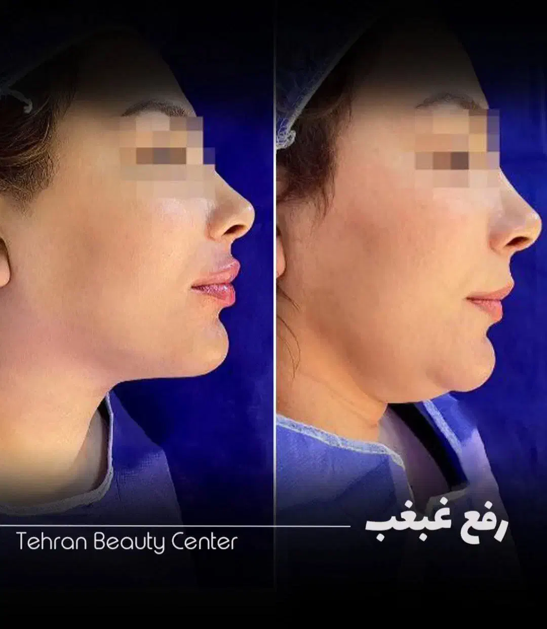 کاشت مو و ابرو/بوتاکس/بلفاروپلاستی/رفع غبغب/اقساطی|خدمات آرایشگری و زیبایی|تهران, سعادت‌آباد|دیوار