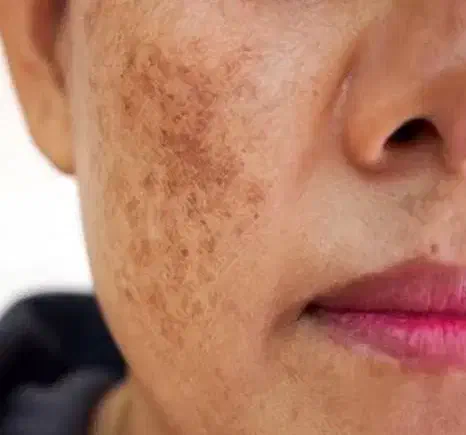 درمان لک صورت|آرایشی، بهداشتی، درمانی|اهواز, کیان اباد|دیوار