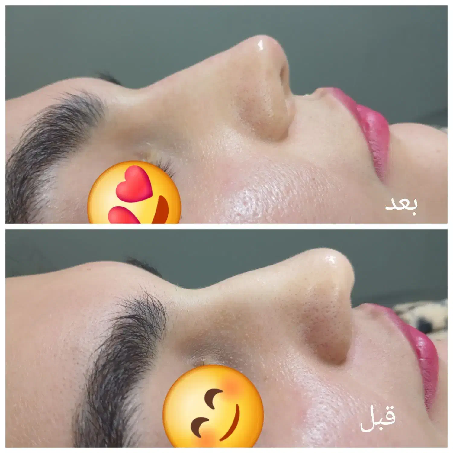 لیزر|خدمات آرایشگری و زیبایی|گلبهار, شهر جدید گلبهار|دیوار