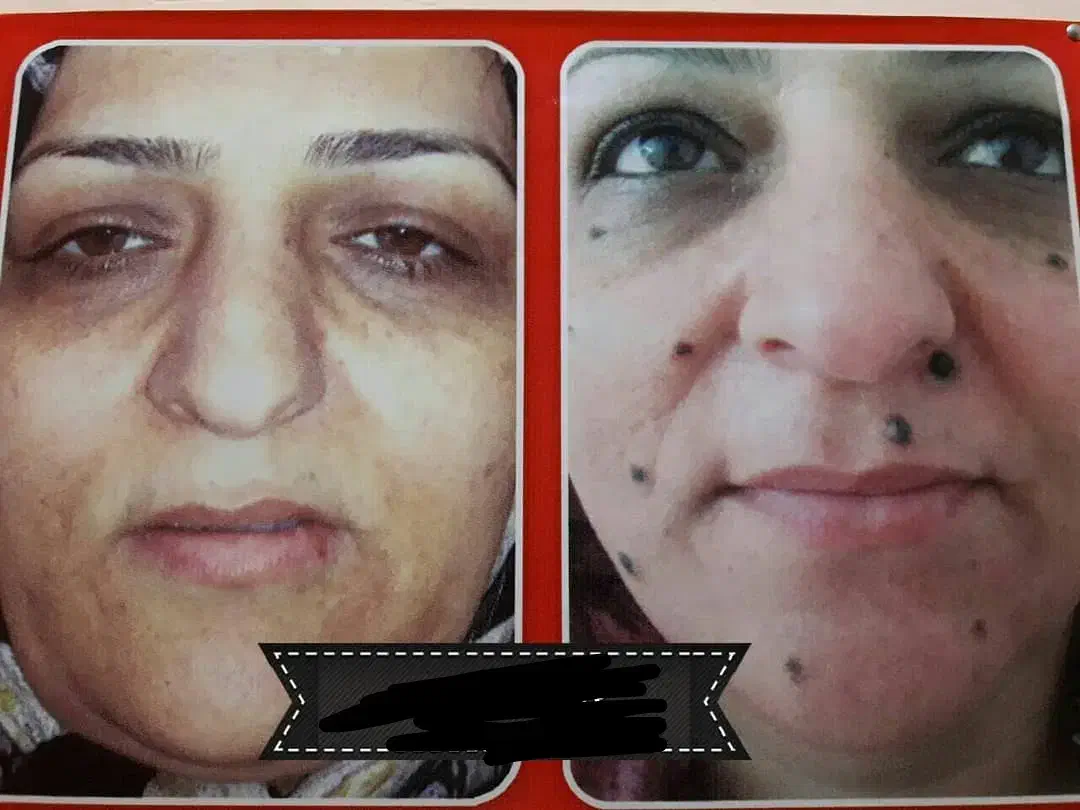 مدل ، برداشتن خال و زگیل و میخچه|خدمات آرایشگری و زیبایی|سقز, |دیوار