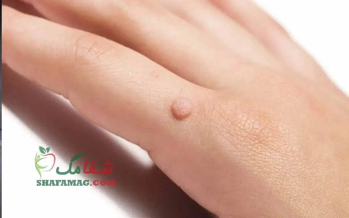 محلول درمان زگیل و زگیل تناسلی|آرایشی، بهداشتی، درمانی|میناب, |دیوار