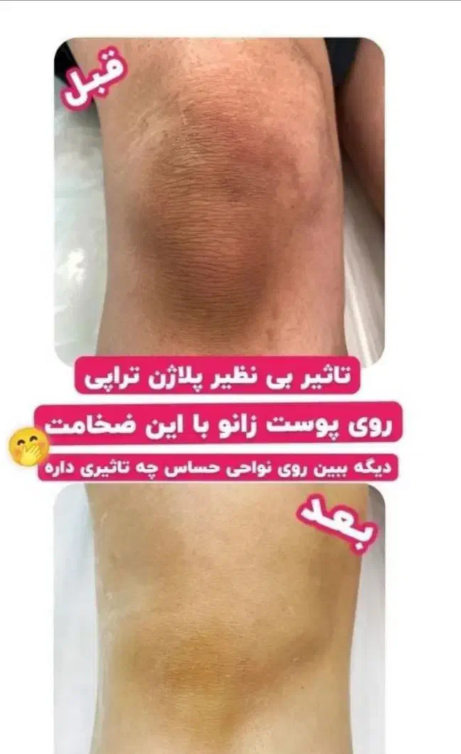 لیزر موهای زائد بدن|خدمات آرایشگری و زیبایی|شیراز, تحویلی|دیوار