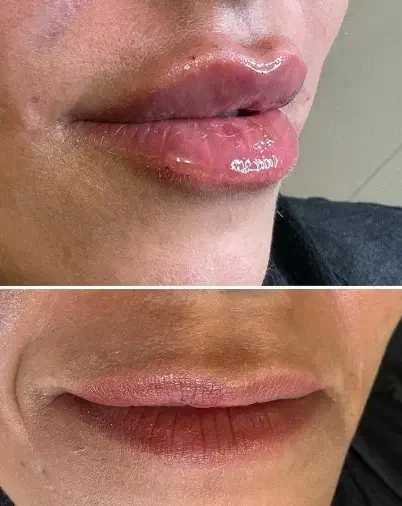 مدل برای فیلر لب و بوتاکس|خدمات آرایشگری و زیبایی|کرمانشاه, |دیوار