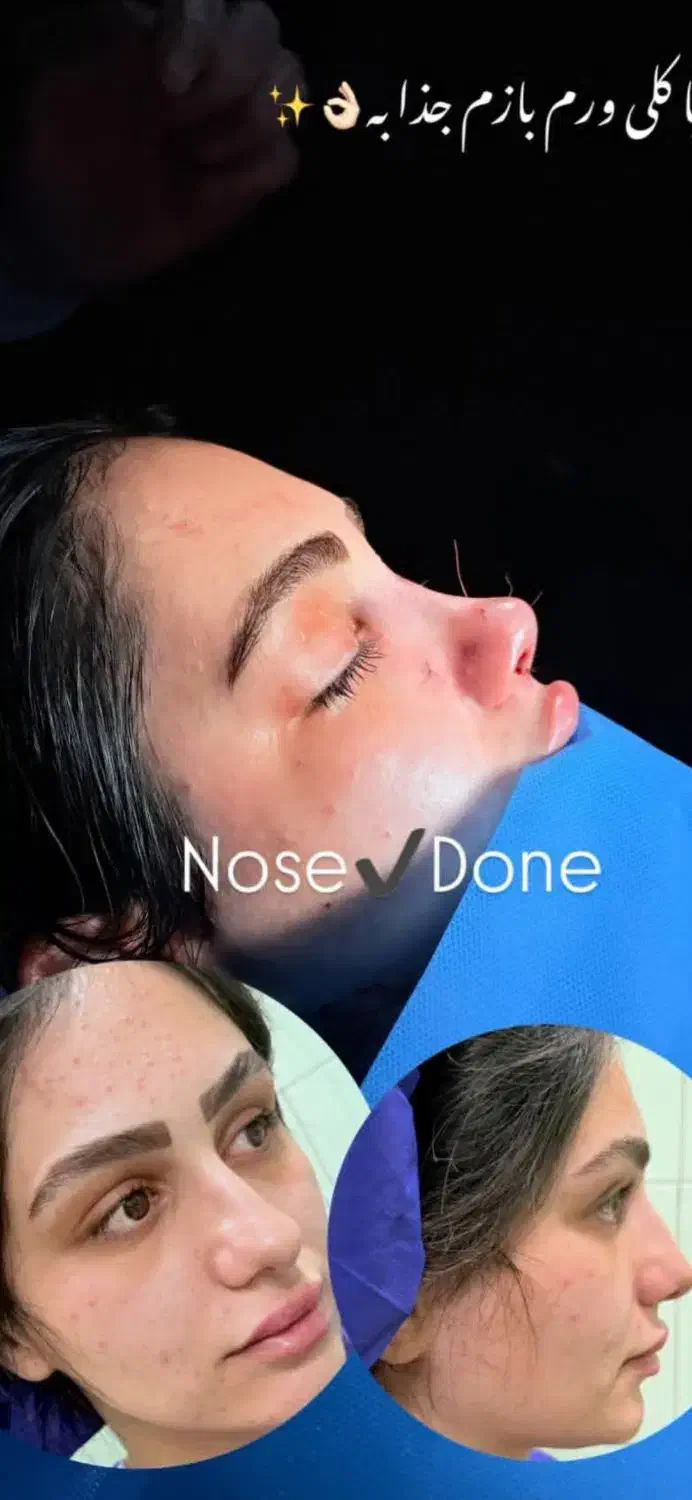 جراحی بینی فقط ۸و۹ آذر فقط۲۹ میلیون تومان|خدمات آرایشگری و زیبایی|فریدونشهر, |دیوار