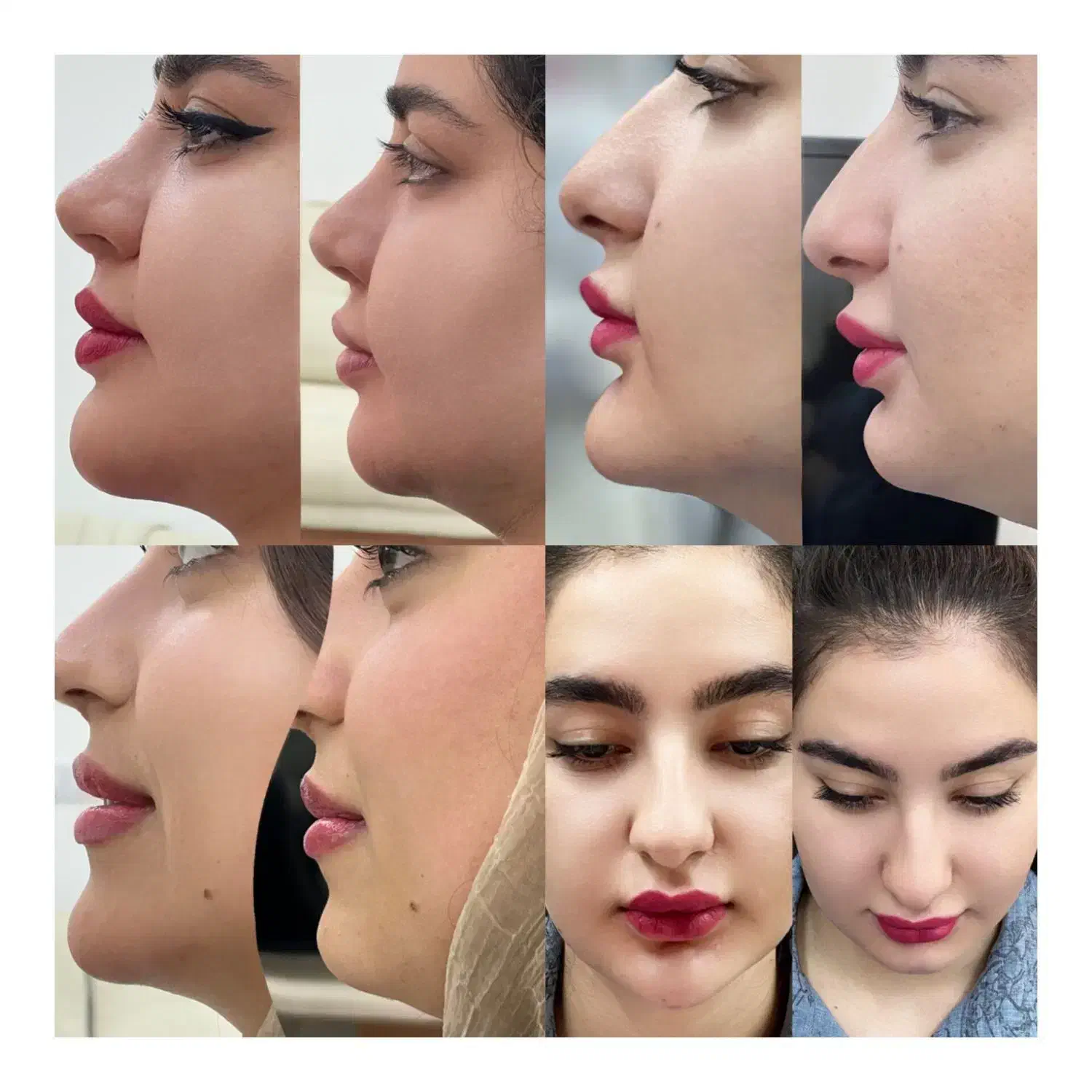 تزریق انواع ژل و بوتاکس|خدمات آرایشگری و زیبایی|شیراز, شهرک والفجر|دیوار
