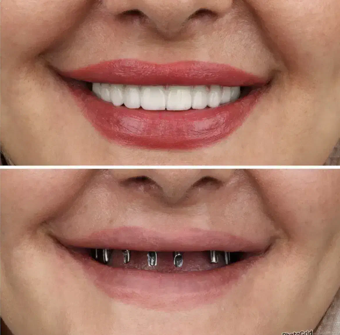 ایمپلنت با اقساط بلند مدت در تبریز|خدمات آرایشگری و زیبایی|اهر, |دیوار