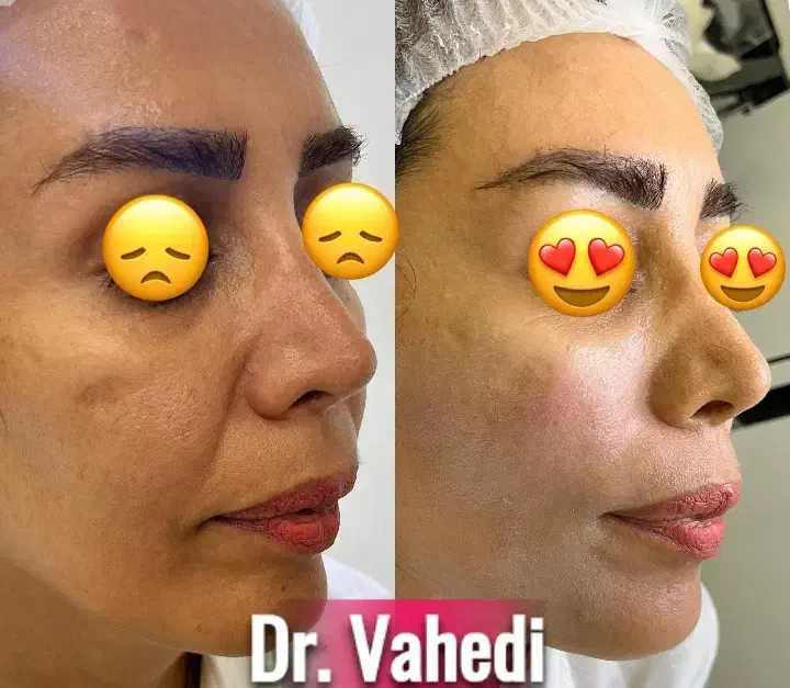 تخفیف ویژه لیفت و جوانسازی صورت|خدمات آرایشگری و زیبایی|مشهد, چهارچشمه|دیوار