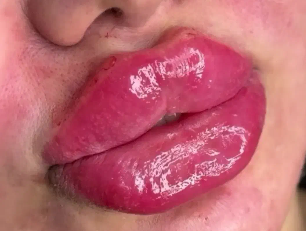 تزریق ژل و بوتاکس|خدمات آرایشگری و زیبایی|اردبیل, |دیوار