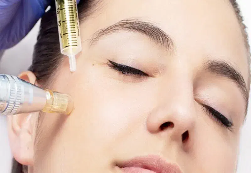 مزونیدلینگ و مزوتراپی موی سر /رفع تیرگی زیر چشم|خدمات آرایشگری و زیبایی|لاهیجان, طالقانی|دیوار