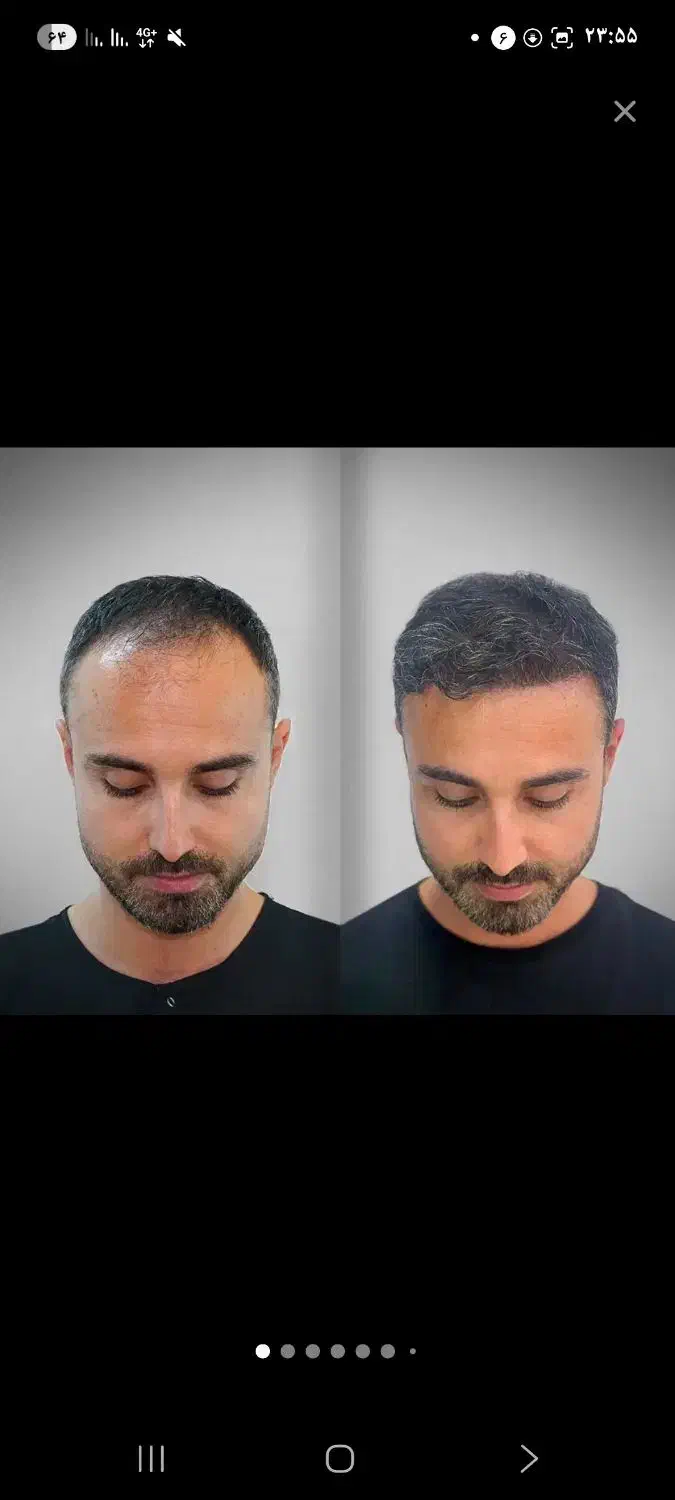 جشنواره کاشت مو دکتر راکعی .اقساط ۱۲ ماهه بدون سود|خدمات آرایشگری و زیبایی|اراک, |دیوار