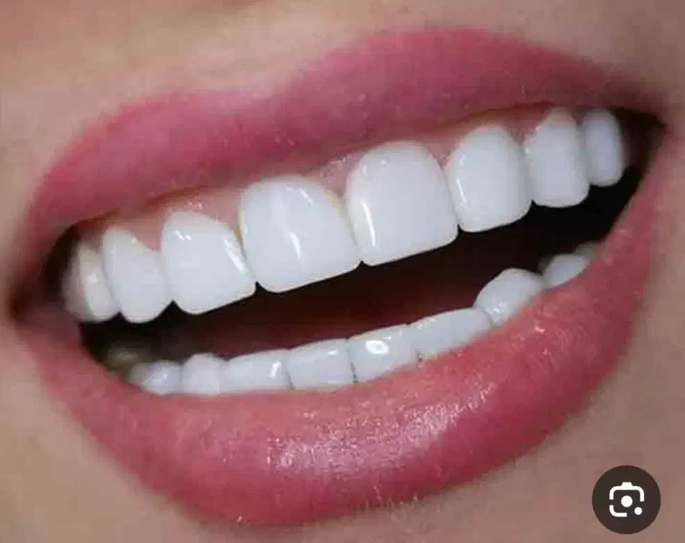 جشنواره کامپوزیت دندان فقط واحدی 700|خدمات آرایشگری و زیبایی|فولادشهر, B4|دیوار