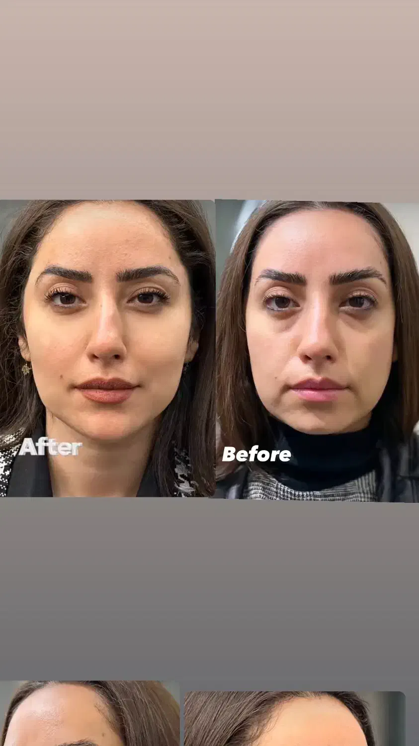 تخفیفات استثنایی ژل و بوتاکس در مطب زیبایی|خدمات آرایشگری و زیبایی|قم, دورشهر|دیوار