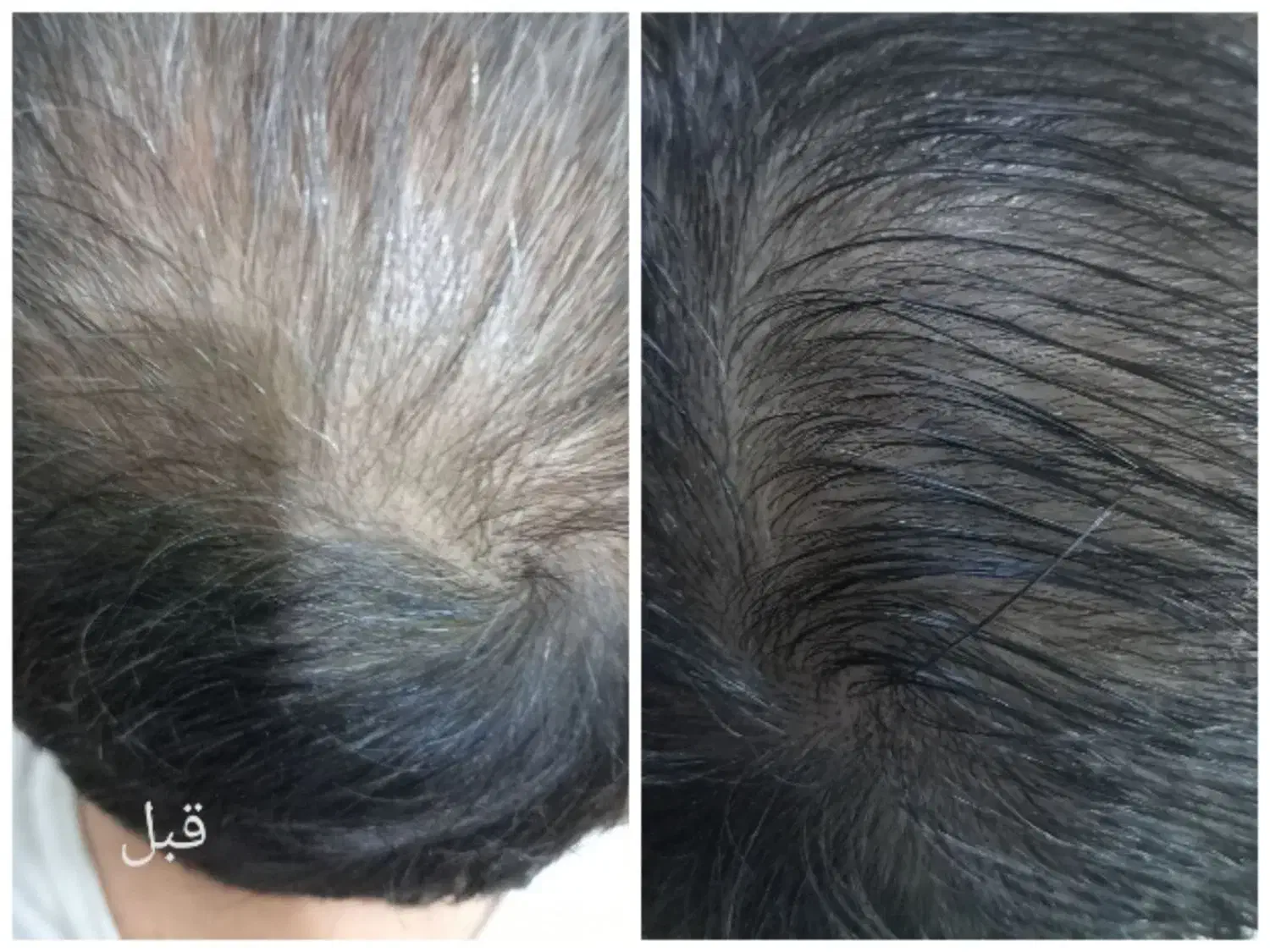 با تونیک ضدریزش آریا موهای ریختتو برگردون|آرایشی، بهداشتی، درمانی|کرمان, |دیوار