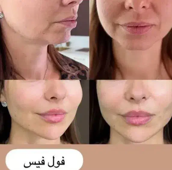 فیلر لیفت بینی و صورت وشقیقه مزوتراپی بوتاکس|خدمات آرایشگری و زیبایی|تهران, تهرانپارس جنوبی|دیوار