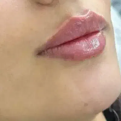 تزریق ژل وبوتاکس باموادکره ای وفرانسه،فشیال،تتو|خدمات زیبایی و سلامت|تبریز, |دیوار