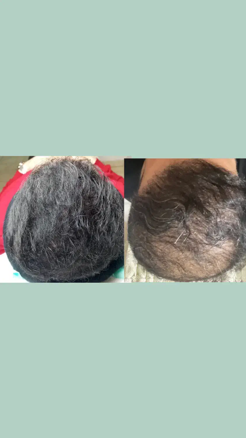 میکرواسکالپ سر|خدمات آرایشگری و زیبایی|گرگان, |دیوار