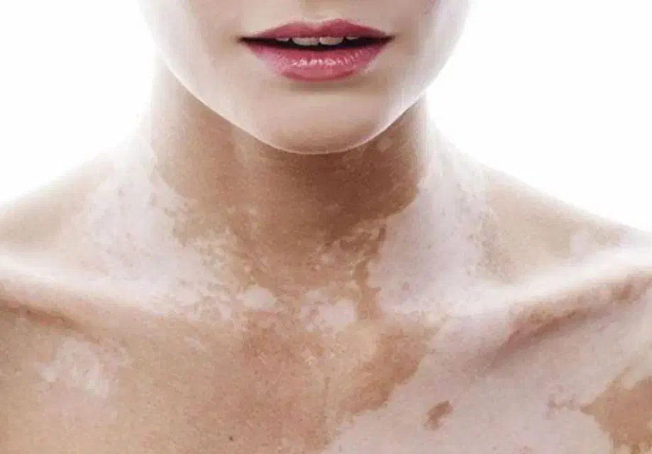 درمان انواع بیماریهای پوستی|آرایشی، بهداشتی، درمانی|شاهرود (اردبیل), |دیوار