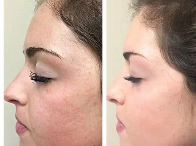 آف پاکسازی پوست صورت|خدمات آرایشگری و زیبایی|مسجد سلیمان, |دیوار