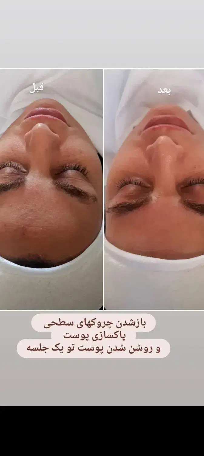 پاکسازی وآبرسانی پوست باتخفیف|خدمات آرایشگری و زیبایی|مرند, |دیوار