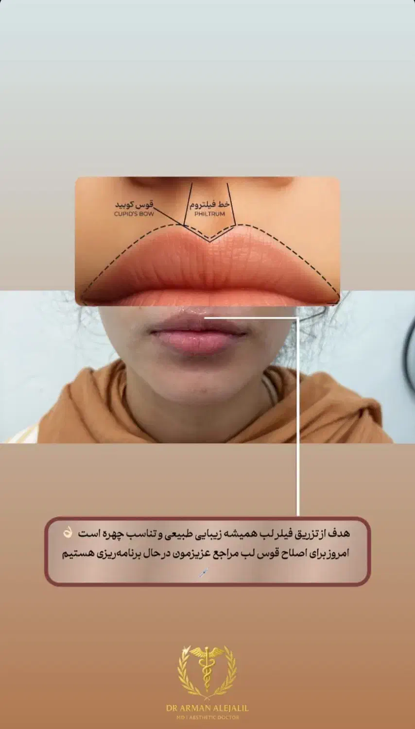 آخرین تخفیف ژل و فیلر، بوتاکس، مزوتراپی، پی آرپی|خدمات آرایشگری و زیبایی|آق قلا, |دیوار