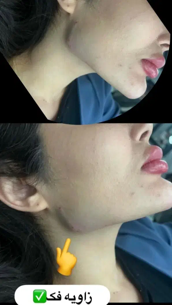 ژل بوتاکس 550|خدمات آرایشگری و زیبایی|پرند, فاز ۵|دیوار