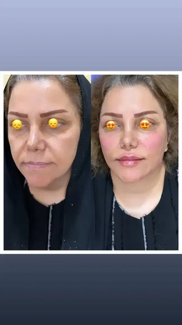 مدل برای درمان افتادگی های صورت و ژل لب و بوتاکس|خدمات آرایشگری و زیبایی|تهران, میرداماد|دیوار