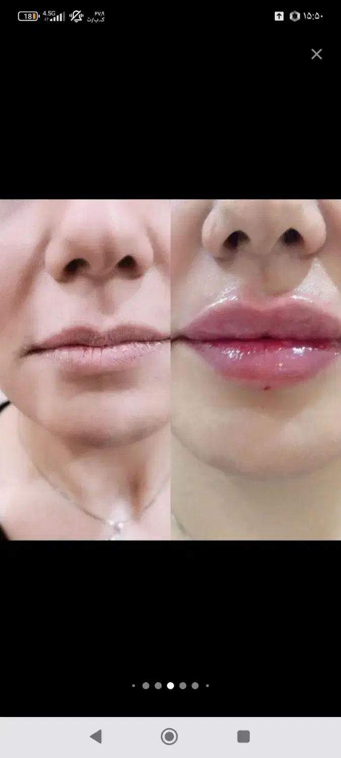 تزریق ژل،بوتاکس درمکانی مستقل بارعایت اصول بهداشتی|خدمات آرایشگری و زیبایی|زاهدان, |دیوار