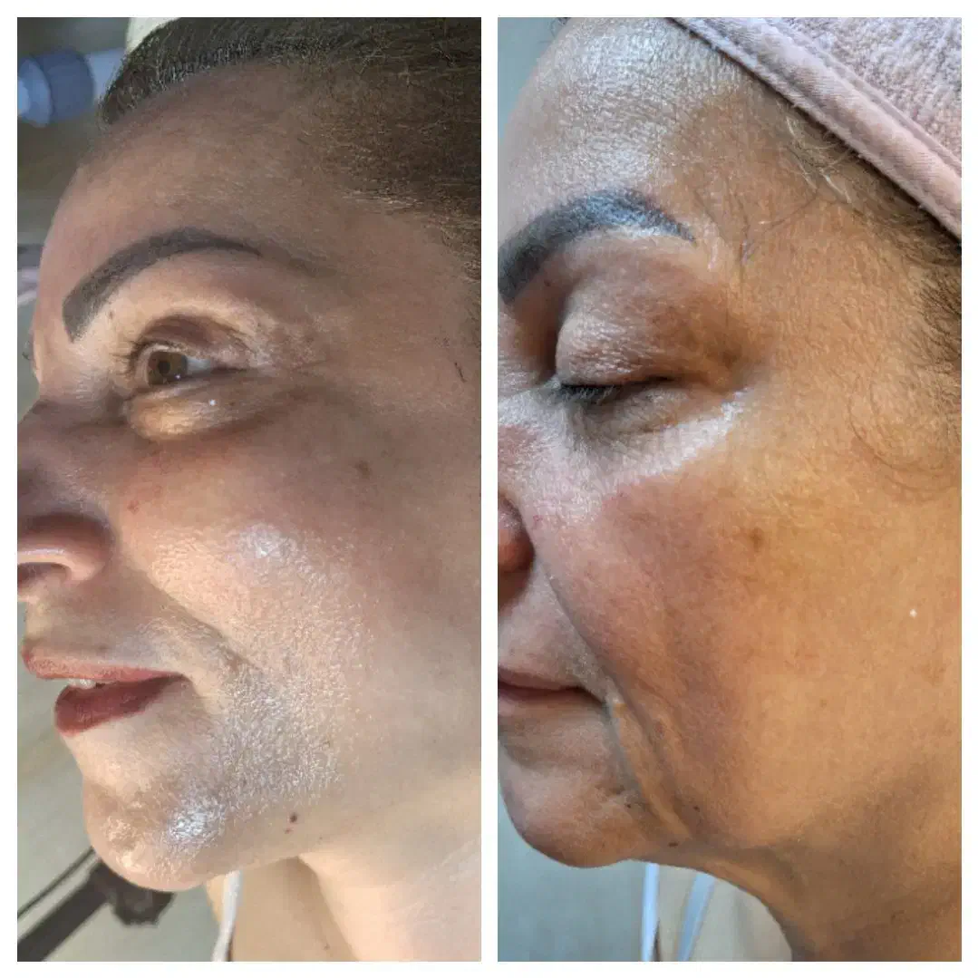 فشیال درمانی‌ رفع ۷۰ درصد اختللات پوستی|خدمات آرایشگری و زیبایی|رشت, دیلمان|دیوار