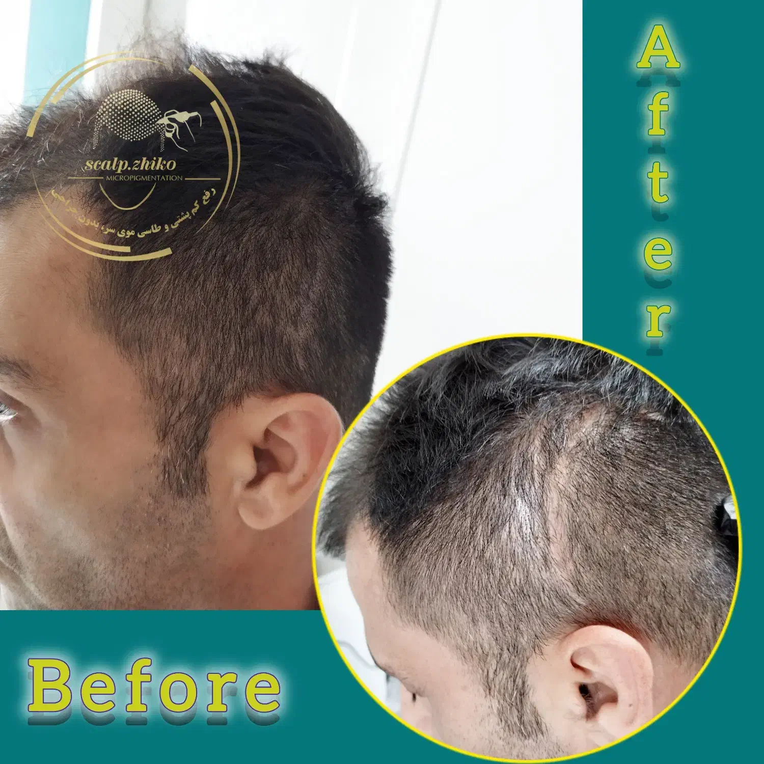 میکرواسکالپ رشد مجدد مو|خدمات آرایشگری و زیبایی|رشت, بوسار|دیوار