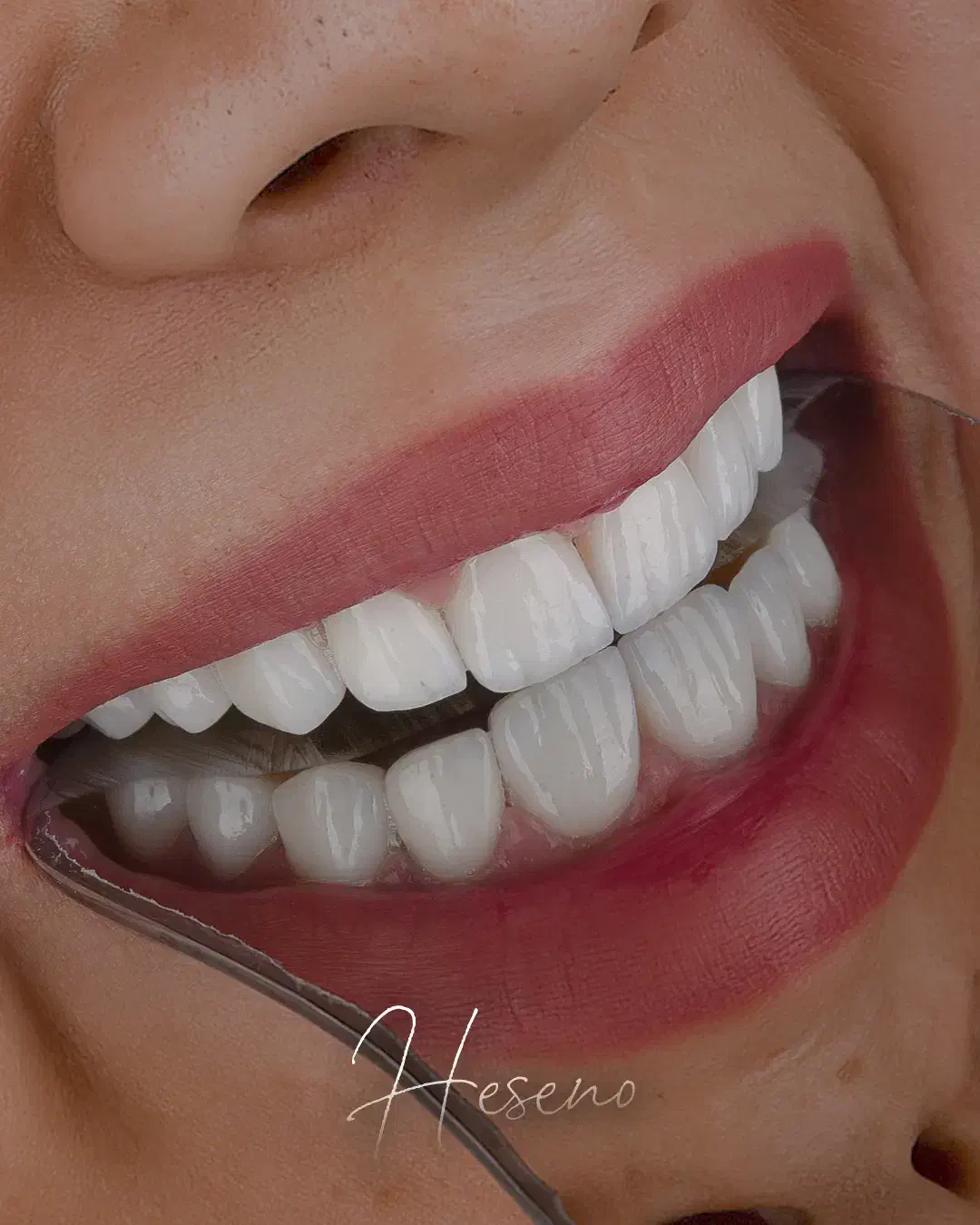 ایمپلنت و لمینیت اقساطی ( فولادشهر )|خدمات آرایشگری و زیبایی|فولادشهر, B2|دیوار